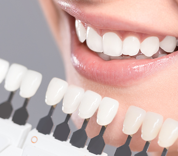 ホワイトニング